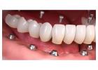 Experience Superior Dental Implant Solutions in Summerlin at Functional Aesthetic Dentistry