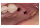 Find top-notch surgeons and dental equipment for Wisdom teeth removal Tijuana