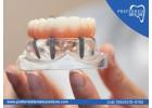 Say Goodbye to Slipping Teeth – Try Our Implants Denture Service