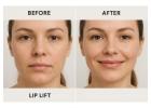 Lip Lifting Surgery Manchester: Transform Your Natural Look