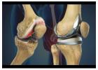 Best Orthopedic Surgeon in Indore for Pain-Free Movement