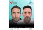 DHI Direct Hair Implantation Turkey – UniquEra Clinic Istanbul