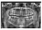 Find minimally invasive Veneers in Tijuana with ultra-thin custom-made shells