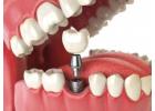 Emergency Dentistry in Abbotsford | Fast, Reliable Emergency Dental Care