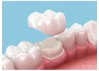 Dental Implants Cost in Abbotsford | Pricing & Treatment Guide