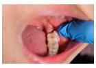 Wisdom Teeth Removal in Abbotsford | Safe & Comfortable Care