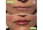 Lip Enhancement Sydney | Results Laser Clinic